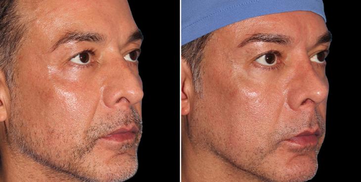 Male Open Rhinoplasty Before & After Atlanta Right View